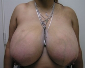 Feel Beautiful - Breast Reduction San Diego 8 - Before Photo